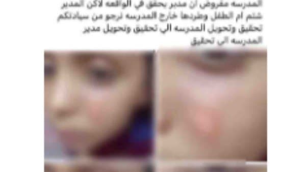 مدرسة تطرد عائلتها وتحرق وجه طالب في سوهاج