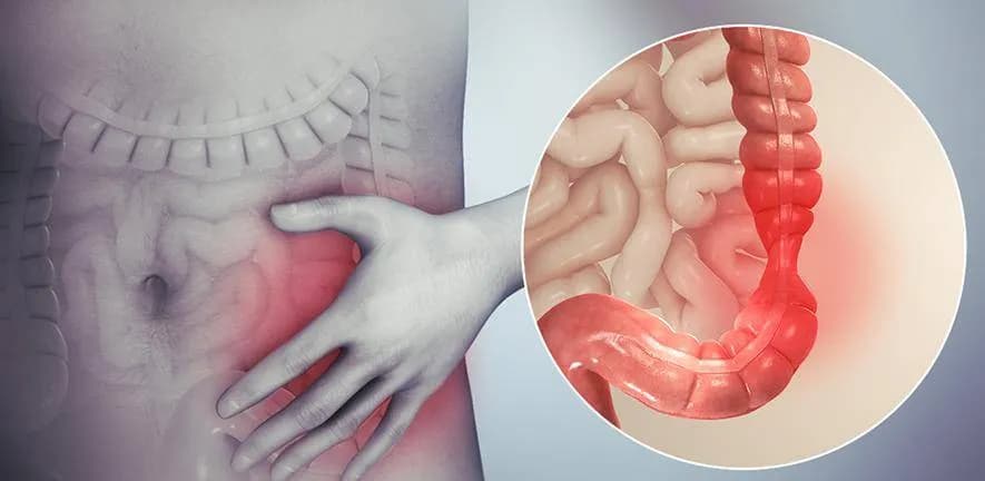 Why Do IBS Flare-Ups Rise Seasonally