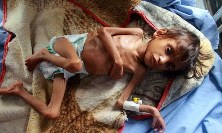 UN: Yemeni children face increased hunger and displacement