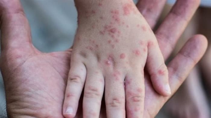 US Worried About School Measles Surge