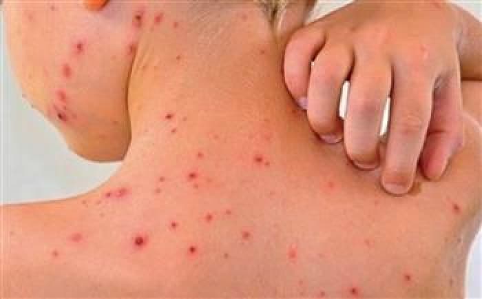الصحة الماليزية تسجل زيادة حادة في حمى الضنك
