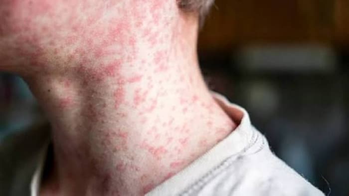 Measles Cases Surge in Pennsylvania