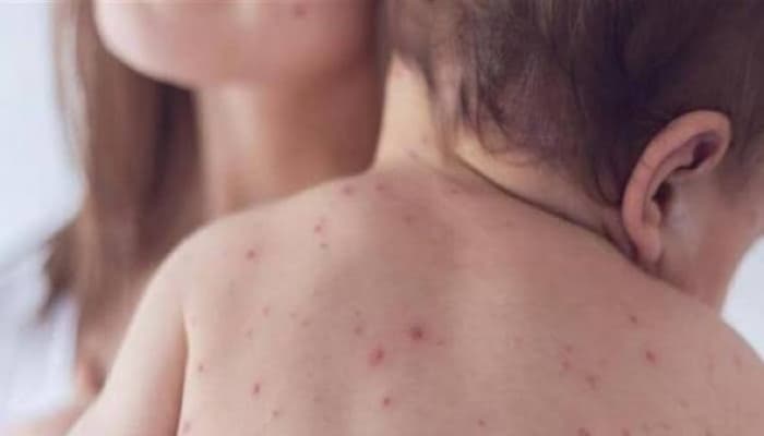 بنجلادش تسجل ارتفاعا في حالات الحصبة