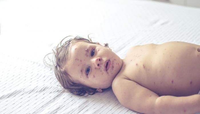 انتشار الحصبة في أمريكا بتسجيل 4410 حالة