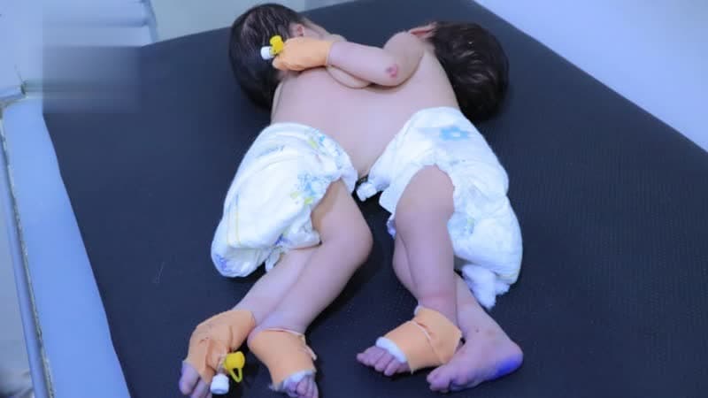 Conjoined Twins at Seventy Hospital Seek Life Amid Isolation