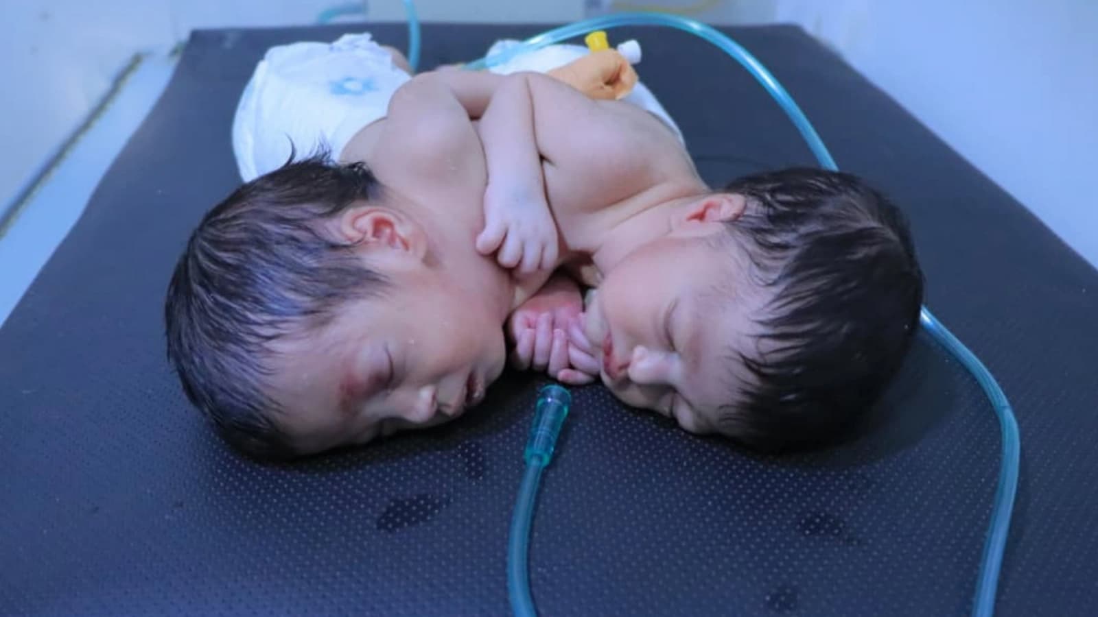 Twin Siamese twins die amid Sana'a airport siege