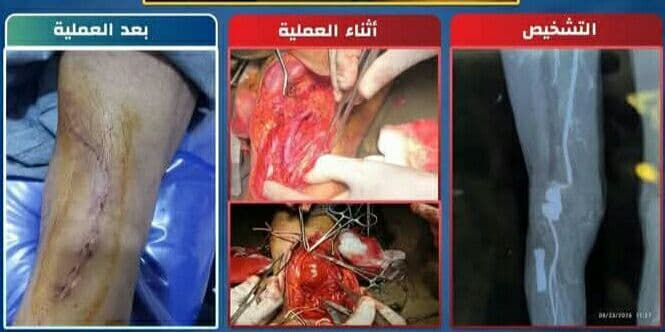 Al-Thawra Hospital officials report successful operation