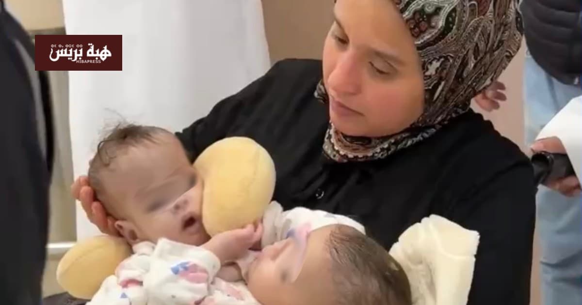 Separation of Moroccan twins Saja and Dhuha in Saudi