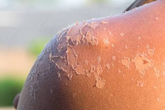 Sunburn treatment after swimming