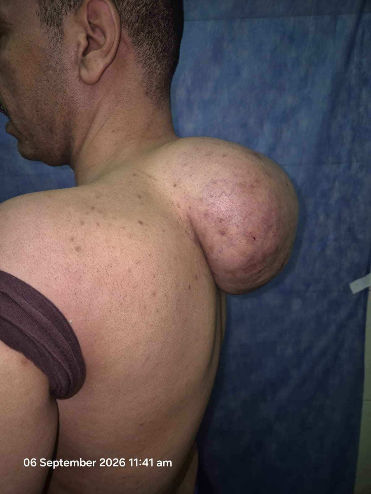 مستشفيات سوهاج تستأصل ورم دهني كبير