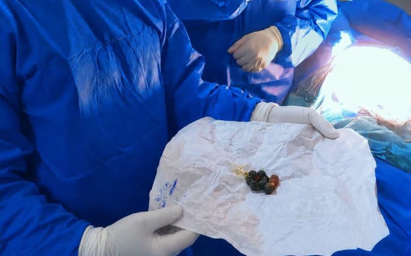 Surgical Success in Girl with 15 Magnets in Kafr El Sheikh