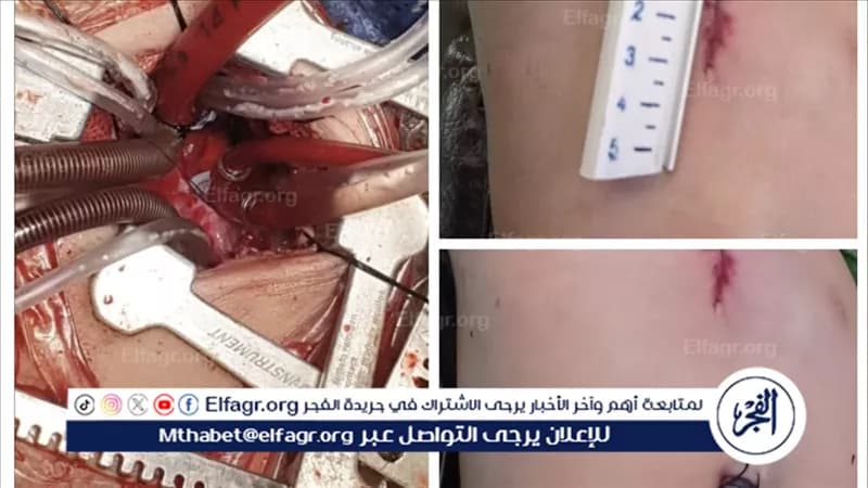 Assiut Medical Team Repairs Child's Heart Defect