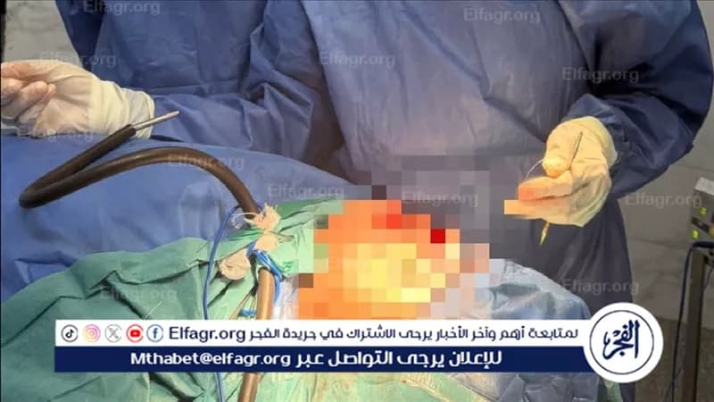 نجاح جراحة لتثبيت كسور عظام الوجه والأسيوط