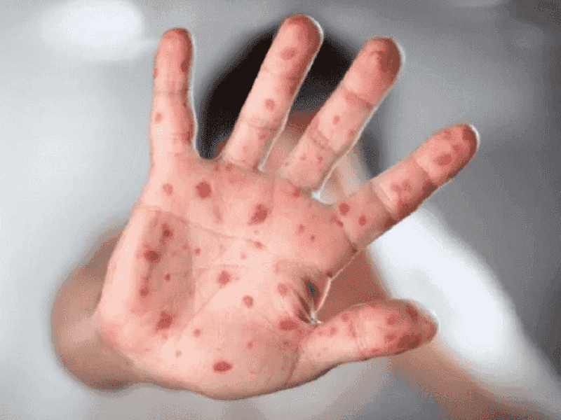 Gaza Faces Rising Child Measles Risk
