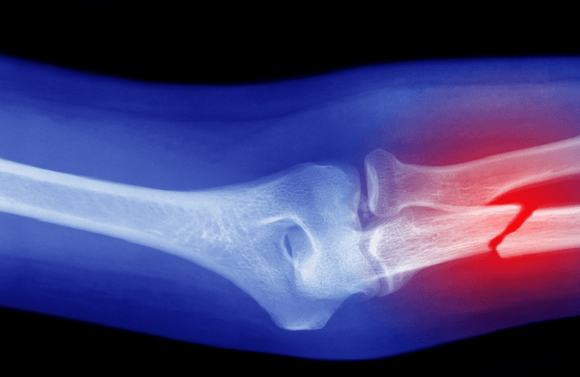 Medications lowering fracture risk in elderly diabetics