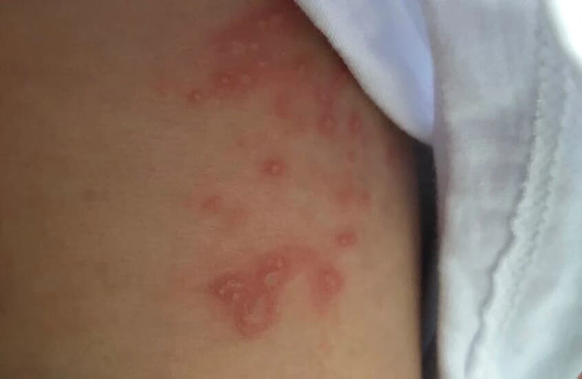 Unforeseen Origin of Skin Abscesses