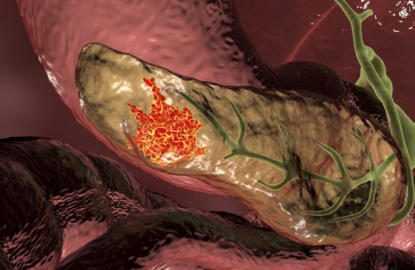 US drug boosts pancreatic cancer survival