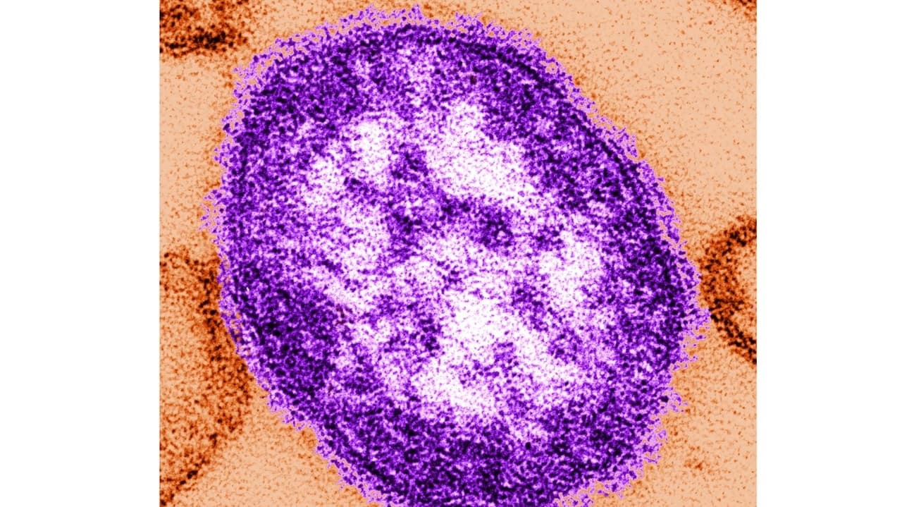 Coroner details infant deaths in Pennsylvania measles outbreak