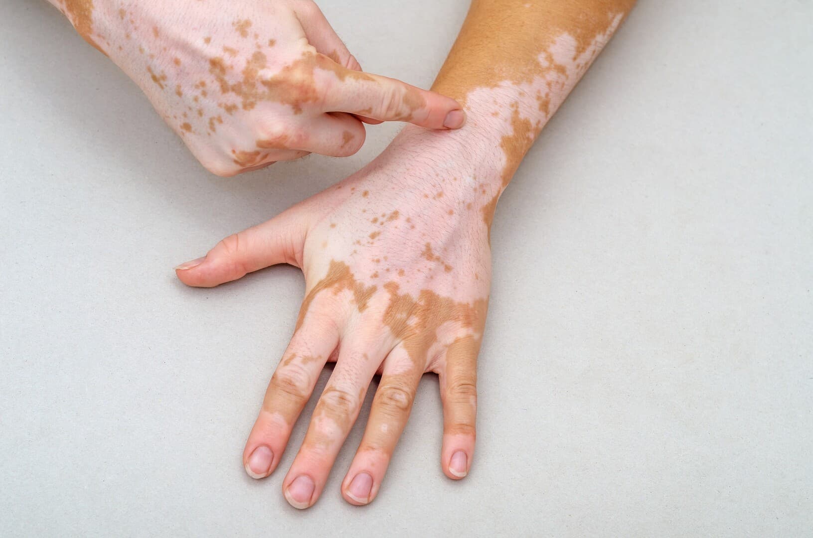 UAE solves vitiligo mystery