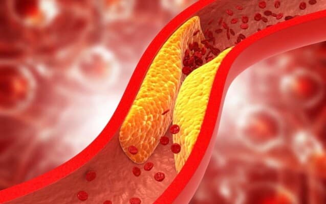 Indicators of high cholesterol on your body