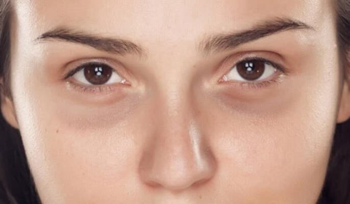 أسباب تغير لون الهالات