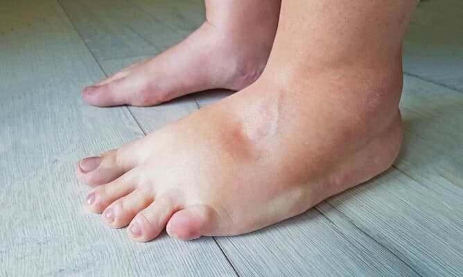 Summer foot swelling causes and remedies