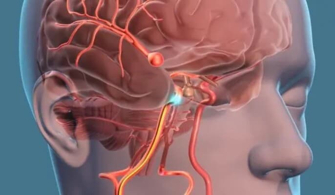 Simple actions that may threaten brain vessels