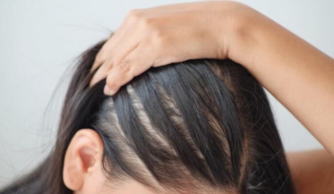 أسباب سرعة دهون الشعر