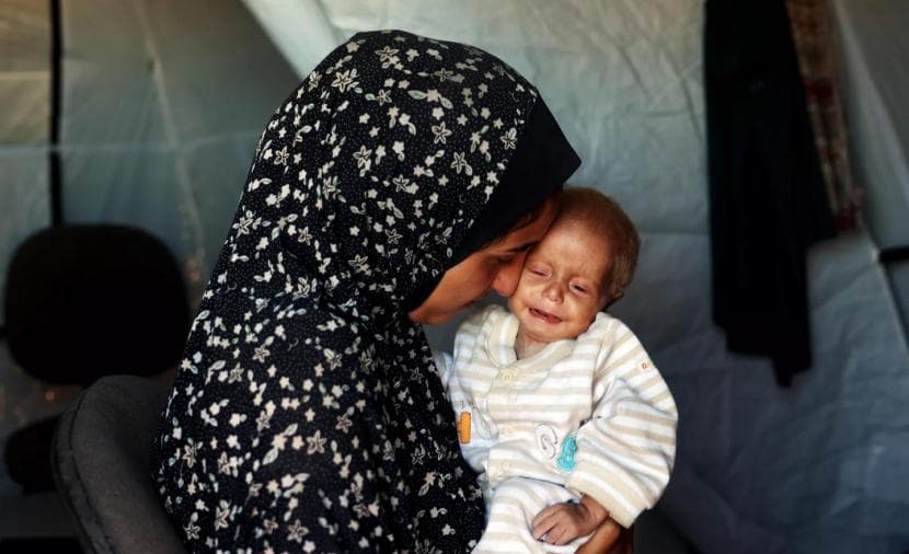 Malnutrition Causes and Prevention