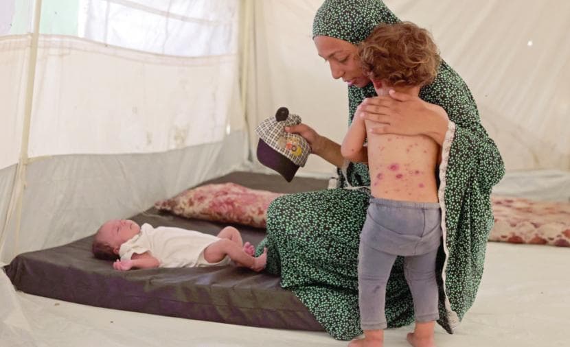 Gaza Reports Over 53,000 Chickenpox Cases This Year