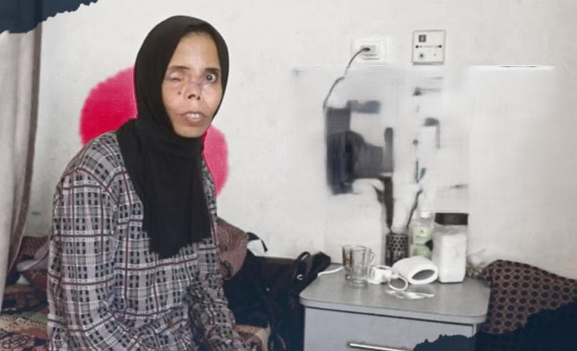 نجوى تروي معاناتها بعد إصابة سلبت نصف وجهها وتركتها أسيرة الألم