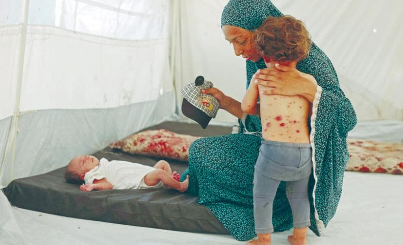 Gaza Reports Over 58,000 Chickenpox Cases