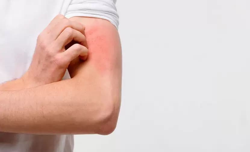 Sunburn effects beyond the skin
