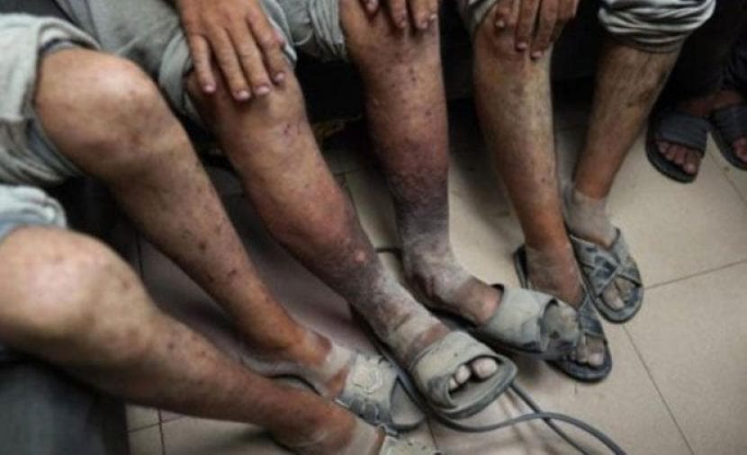 Scabies Plagues Palestinian Prisoners