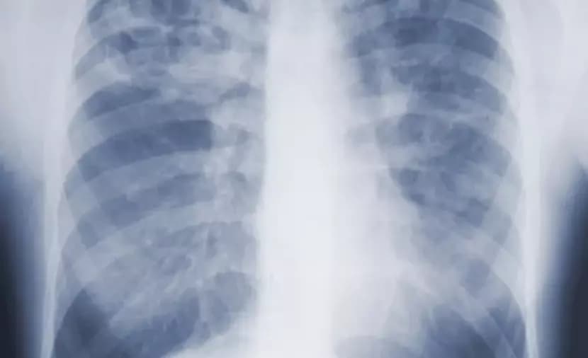 Experimental drug stabilizes lung function in pulmonary fibrosis