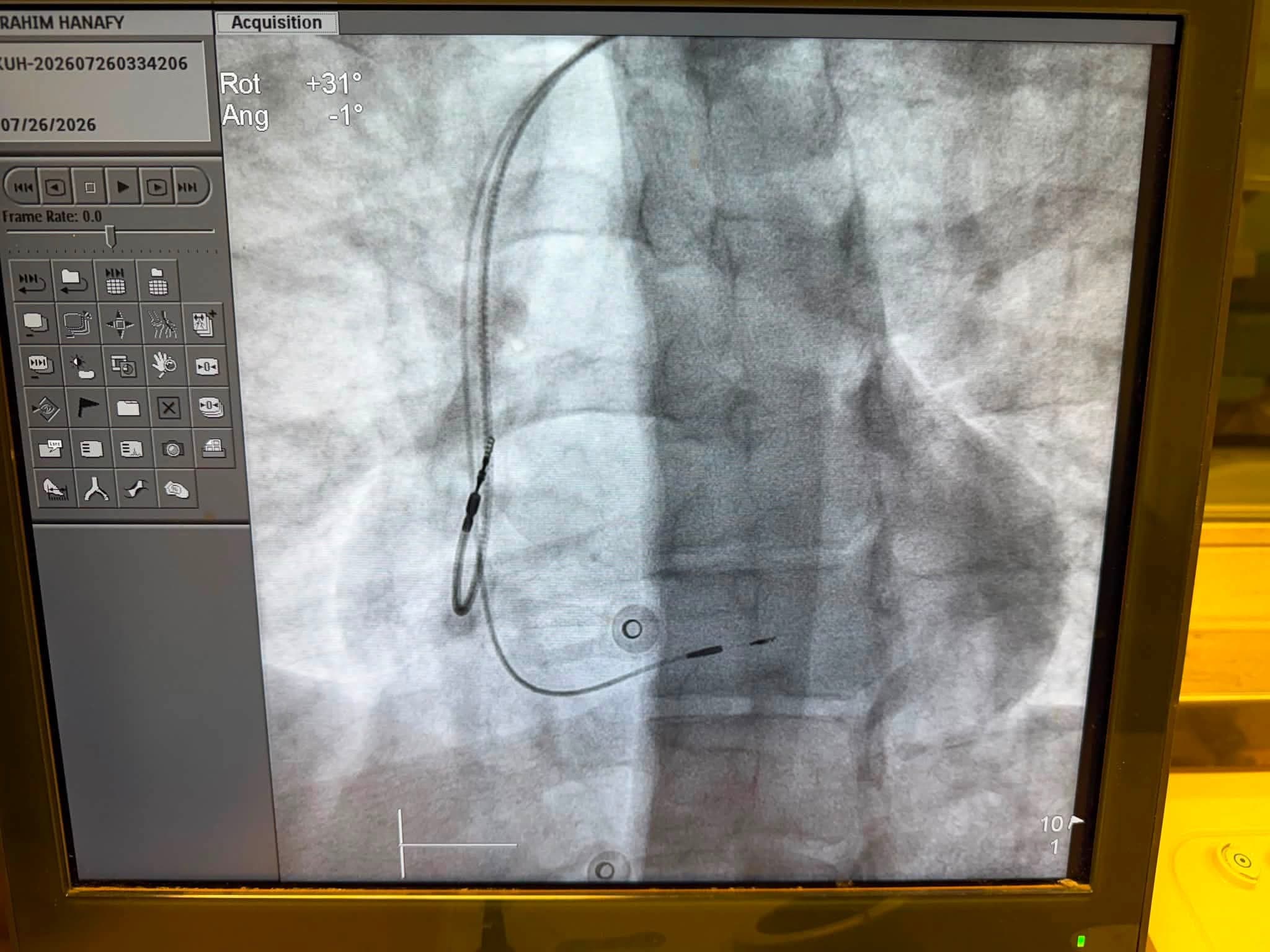 Kafr El Sheikh performs first left bundle pacemaker