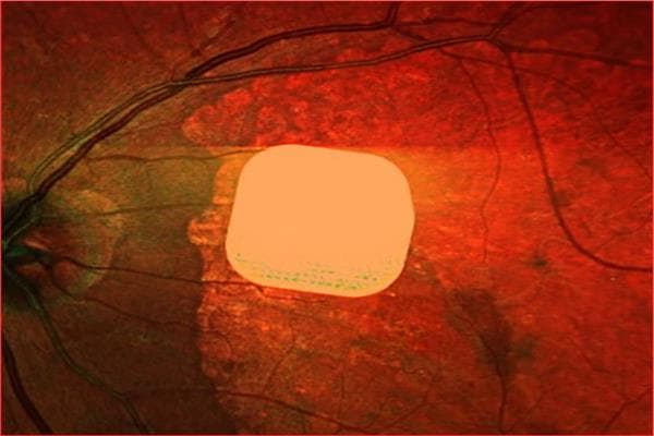 إشادة بنجاح رقاقة إلكترونية لاستعادة الرؤية