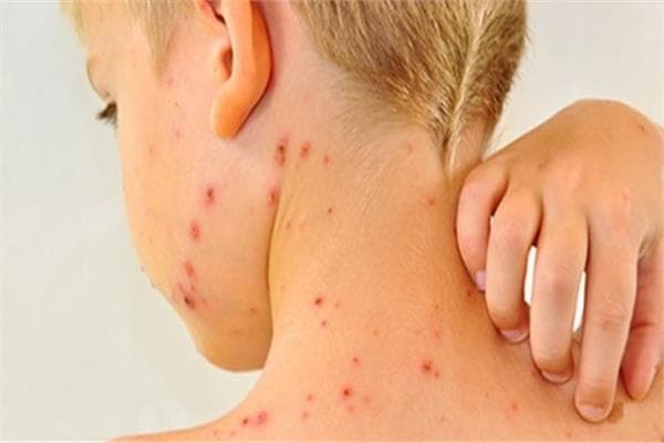 America's 35-Year High in Measles