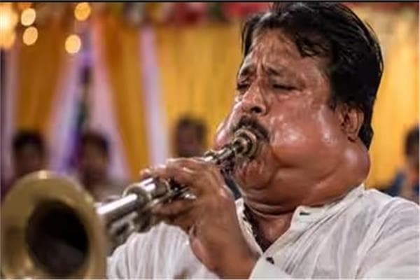 Musician's face and neck swell during concert