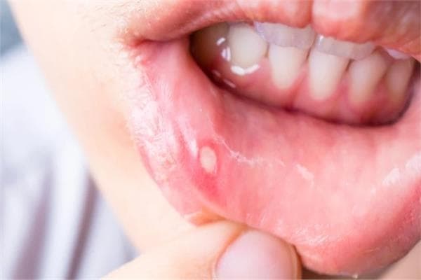 Effective home remedies for mouth soreness