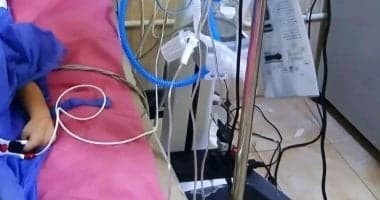 Child Rescued from Brain Hemorrhage in Kafr El Sheikh