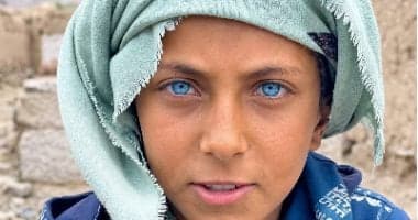 Blue-eyed Yemeni child’s life changes
