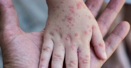 National measles vaccination for children