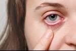 طرق علاج دموع العين