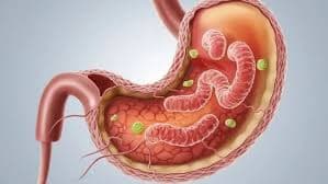 Using garlic and yogurt for Helicobacter pylori