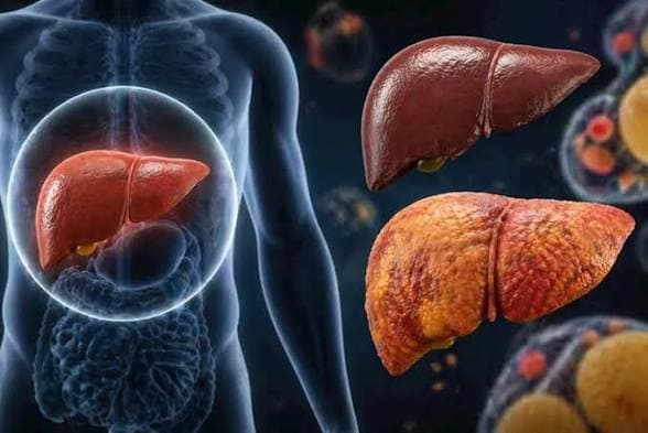أفضل علاج لدهون الكبد وتجنب هذا الطعام