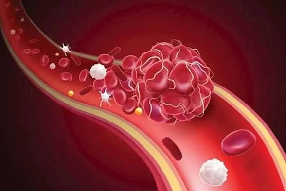 Vitamins Linked to Blood Clots