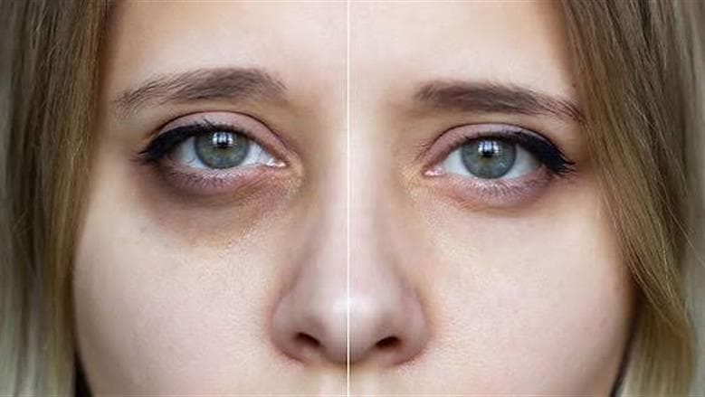 Reasons for Rising Under-Eye Dark Circles