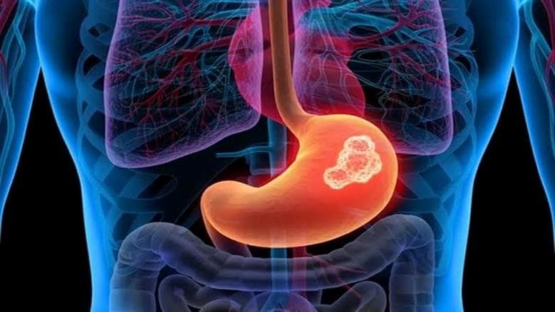 Groups More Prone to Stomach Cancer