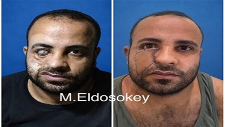 جراحة مصرية تعيد أمل شاب من الصعيد